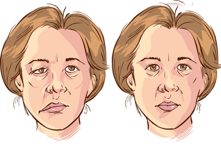 What Causes Bell’s Palsy? – My Little Bird