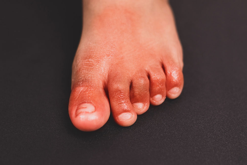 The purply spots of chilblains. 